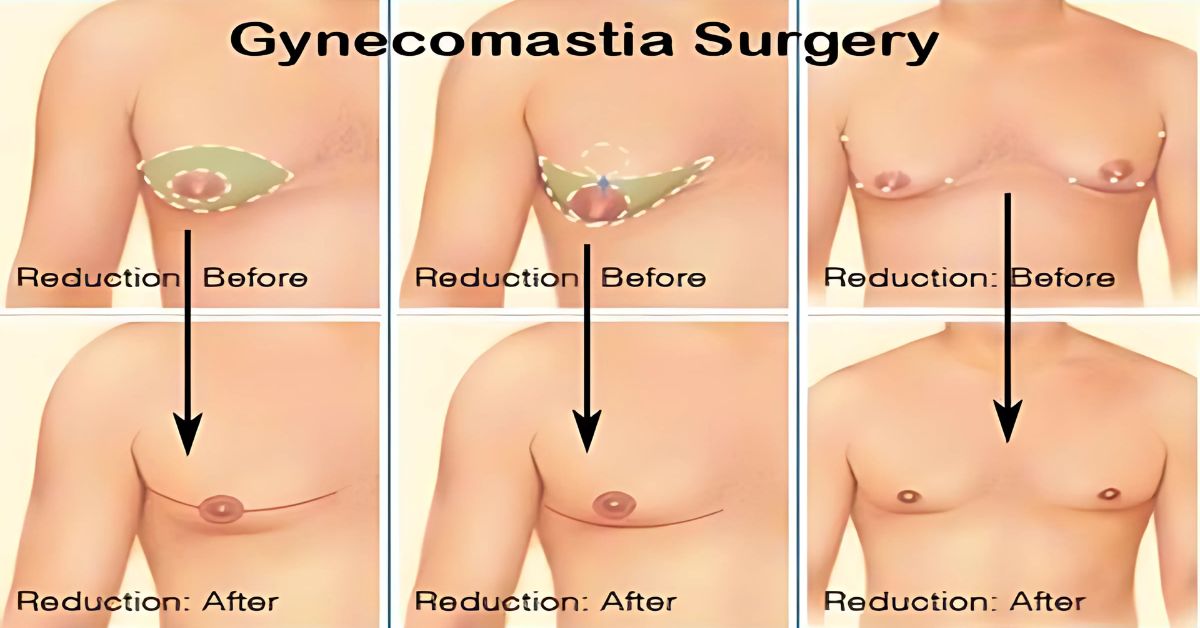 Gynecomastia surgery Procedure with Dr. Vinay Jacob