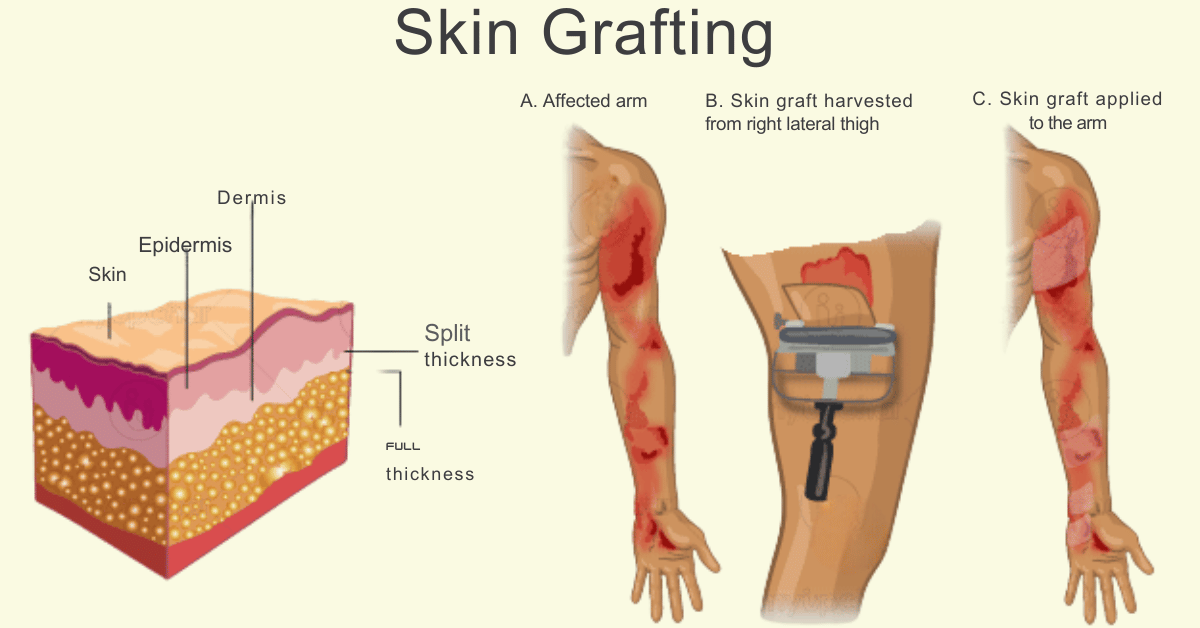 Skin Graft Procedure