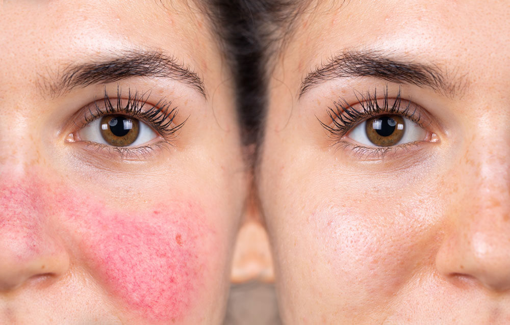 Intense Pulsed Light (IPL) Therapy in Mumbai by Vinay Jacob
