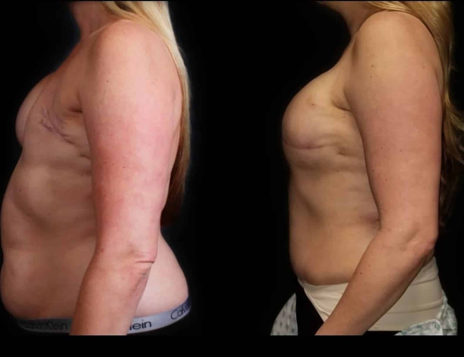 Breast Reconstruction
