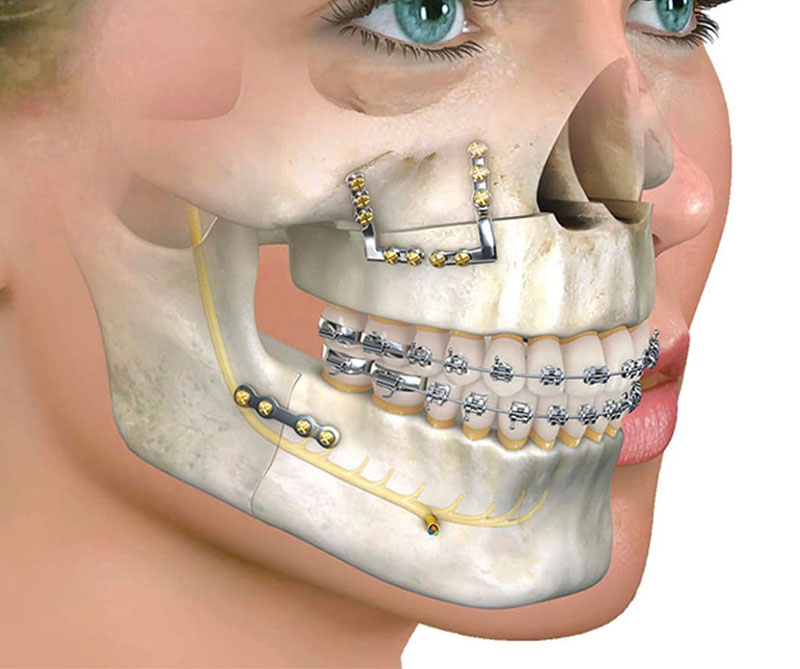 Jaw Reconstruction in Mumbai