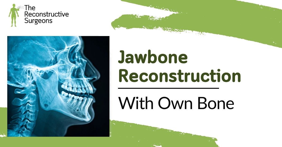 Jawbone Reconstruction with Own Bone in Mumbai