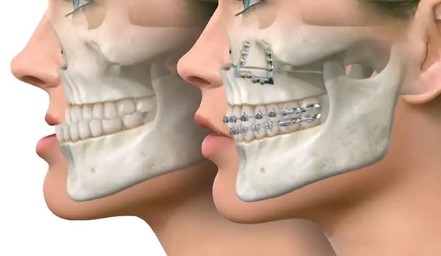 Jawbone Reconstruction With Your Own Bone