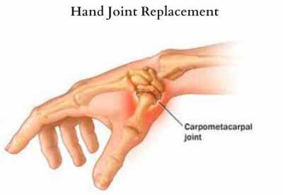 Joint Reconstructive Surgery