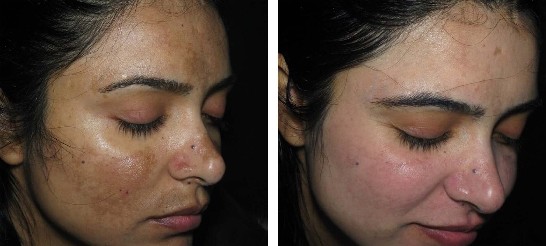 Laser Skin Resurfacing for Pigmentation in Mumbai by Dr. Vinay Jacob