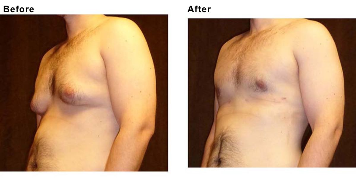 Understanding Gynecomastia in Mumbai with Dr Vinay Jacob
