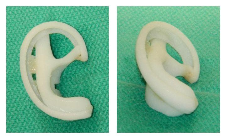 Medpor Implants for Ear Reconstruction In Mumbai