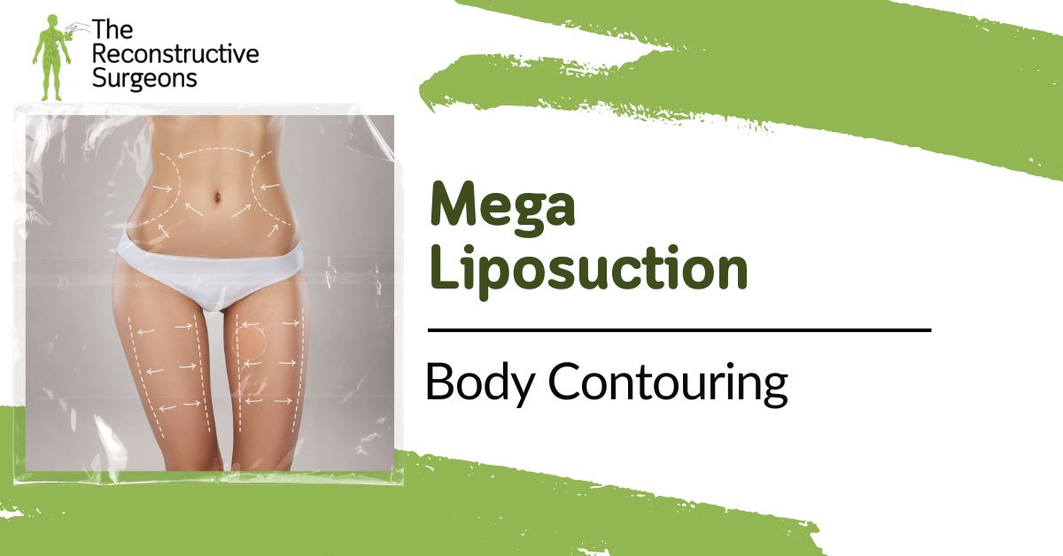 Mega-Liposuction Blog Image