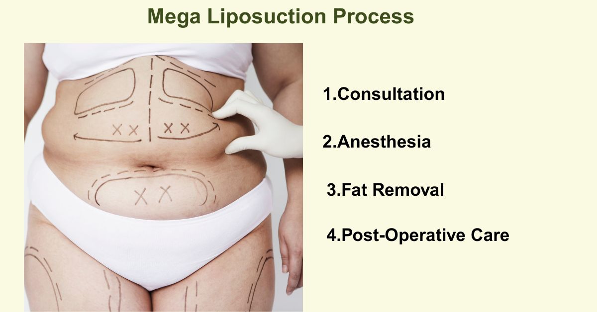 Mega Liposuction process guideline by Dr. Vinay Jacob