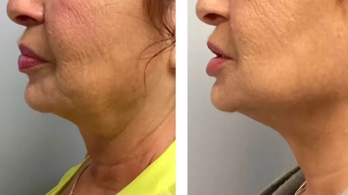 Microneedling for Skin Tightening in Mumbai By Vinay Jacob