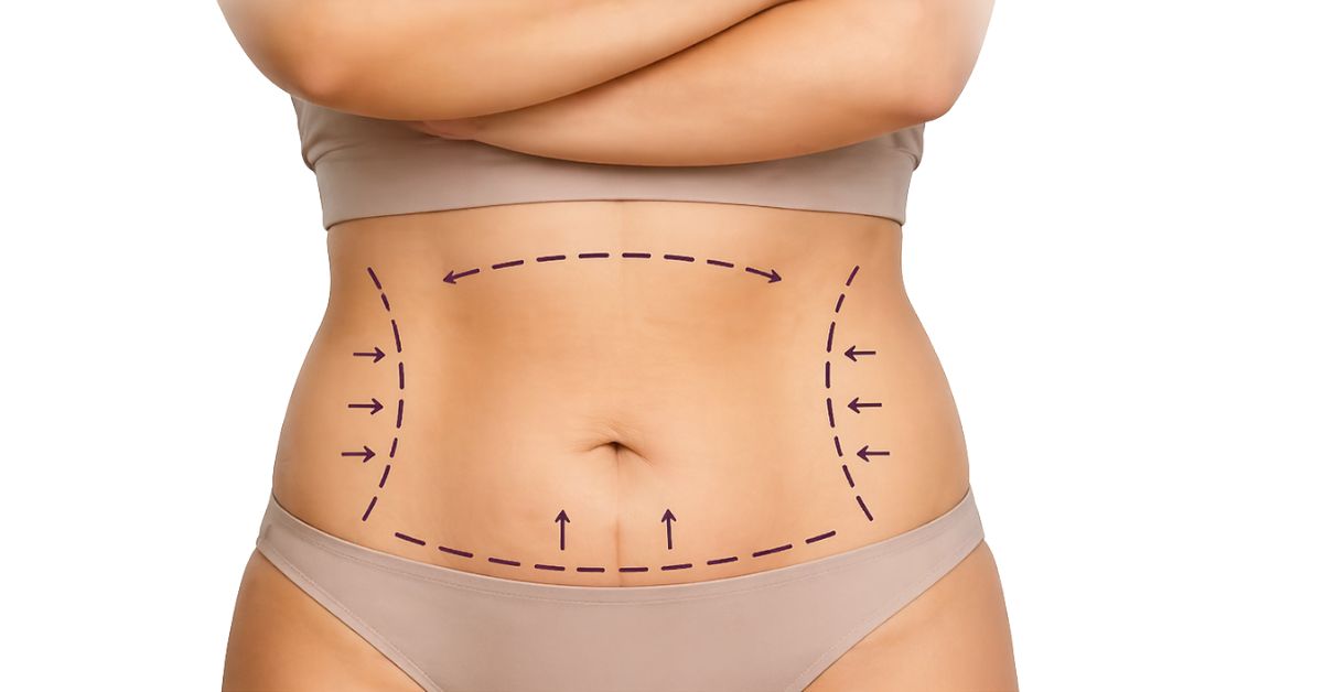 Things I Wish I’d Known Before My Mommy Makeover