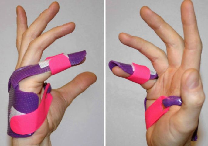 Nerve Repair and Grafting