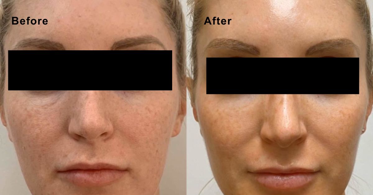 Platelet-Rich Plasma (PRP) Therapy in mumbai
