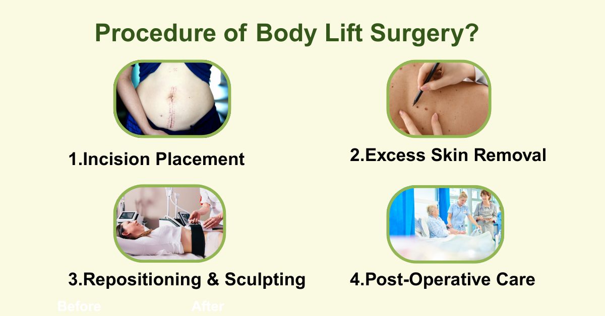 Procedure of Body Lift Surgery in Mumbai with Dr. Vinay Jacob