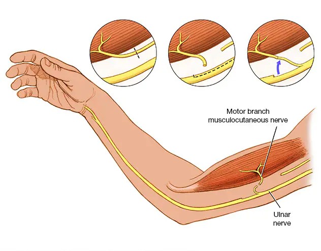Recover from Nerve Injury Surgery in Mumbai With Dr. Vinay Jacob