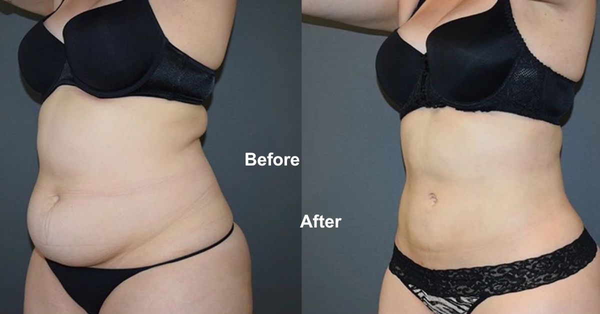 Recovery after mega liposuction in Mumbai by Dr. Vinay Jacob