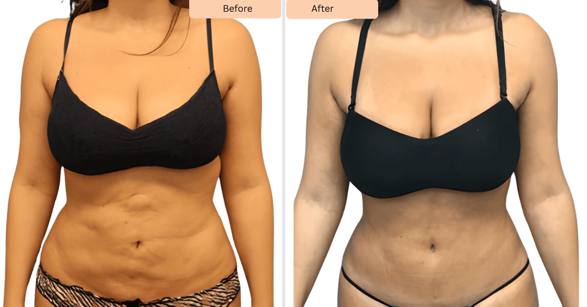 Things I Wish I’d Known Before My Mommy Makeover