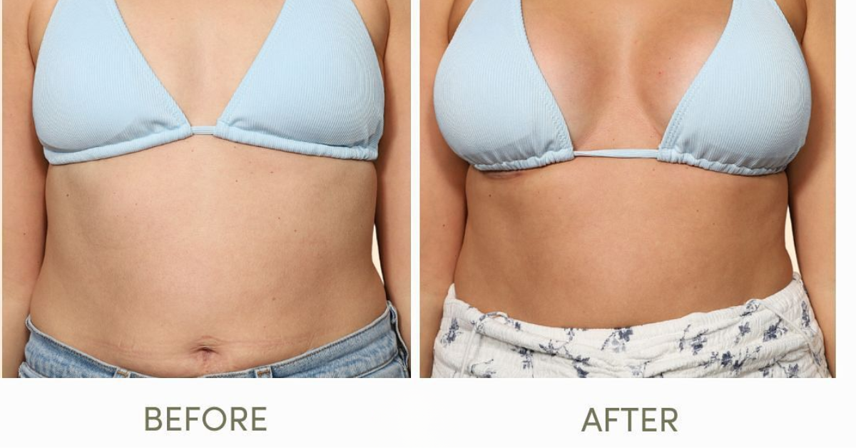 Check Patient Testimonials and Reviews for Breast Augmentation