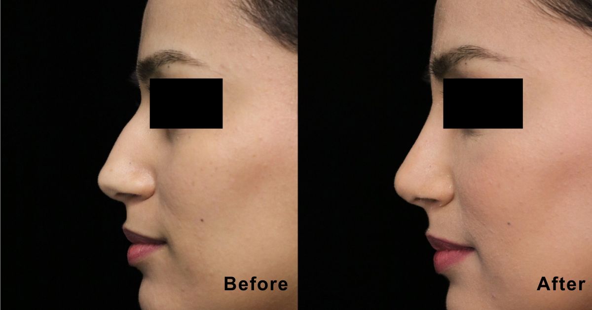 Learn Recovery After Secondary Rhinoplasty in Mumbai with Dr. Vinay Jacob