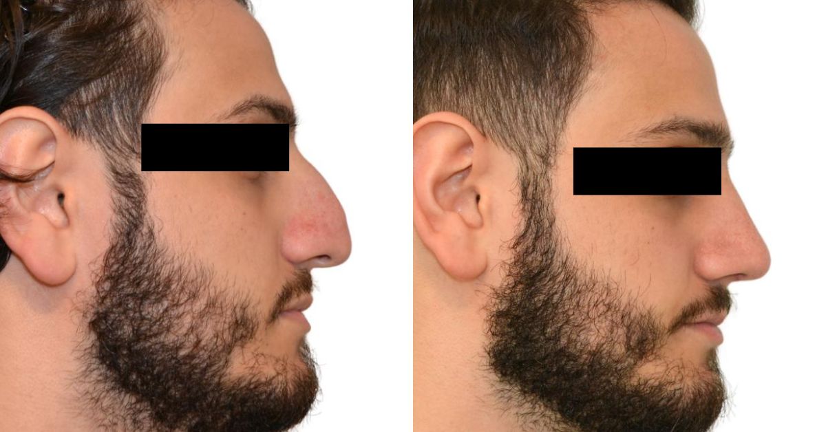Meet Secondary Rhinoplasty Surgeon In Mumbai
