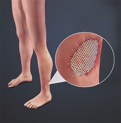 Skin grafting for bed sore treatment in Mumbai By Dr. Vinay Jacob
