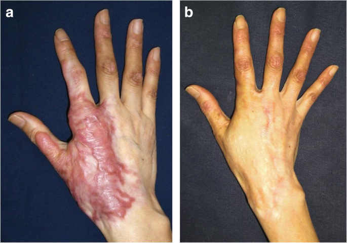 Skin Grafting and Flap Surgery