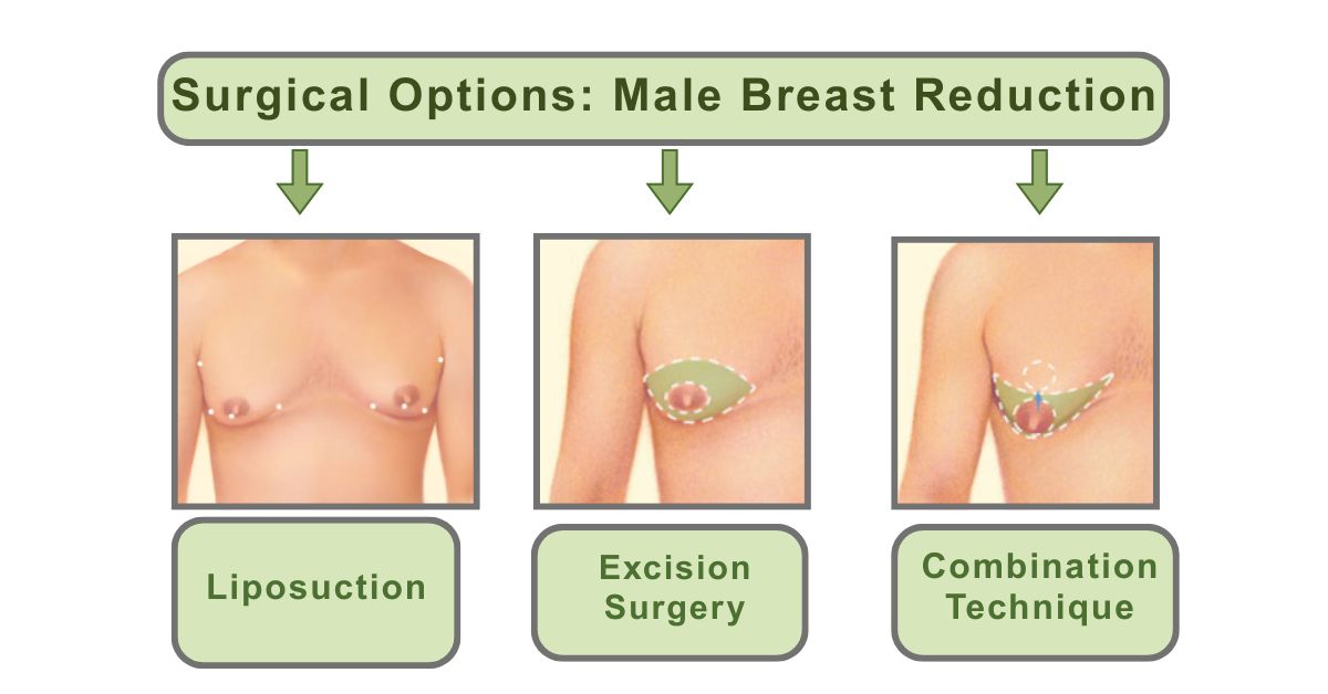 Surgical Options for Male Breast Reduction at Mumbai with Dr. Vinay Jacob