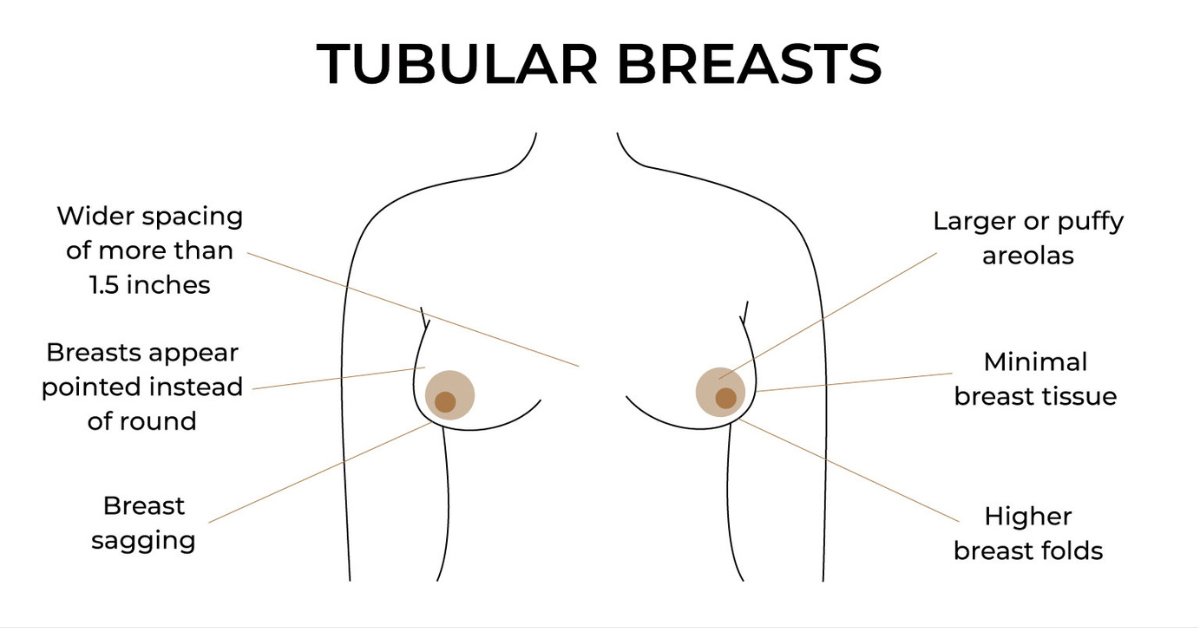 Surgical Solutions for Tuberous Breast Correction