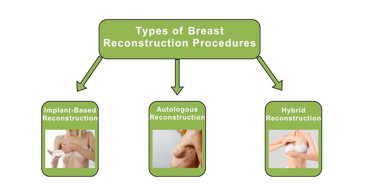 Common Types of Breast Reconstruction Procedures in Mumbai