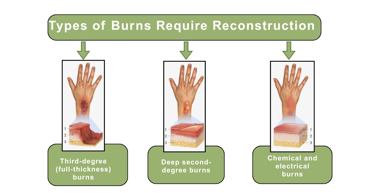 Learn Types of Burns Require Reconstruction in Mumbai with Dr.Vinay Jacob