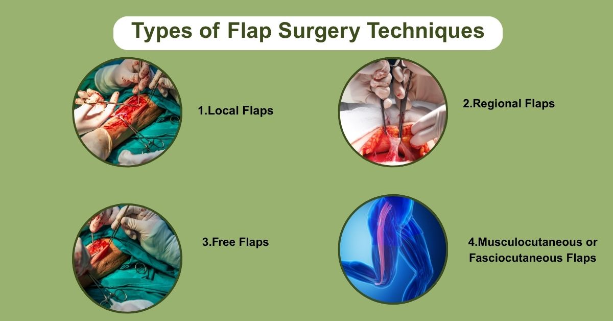 Types of Flap Surgery Techniques in Mumbai