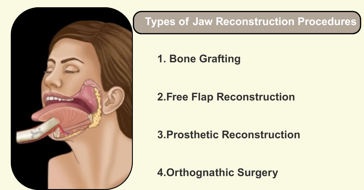 Types of Jaw Reconstruction Procedures in Mumbai