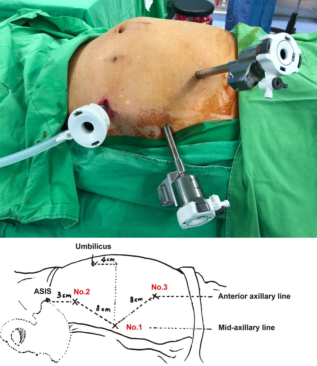 Types of Minimally Invasive Hernia Surgery