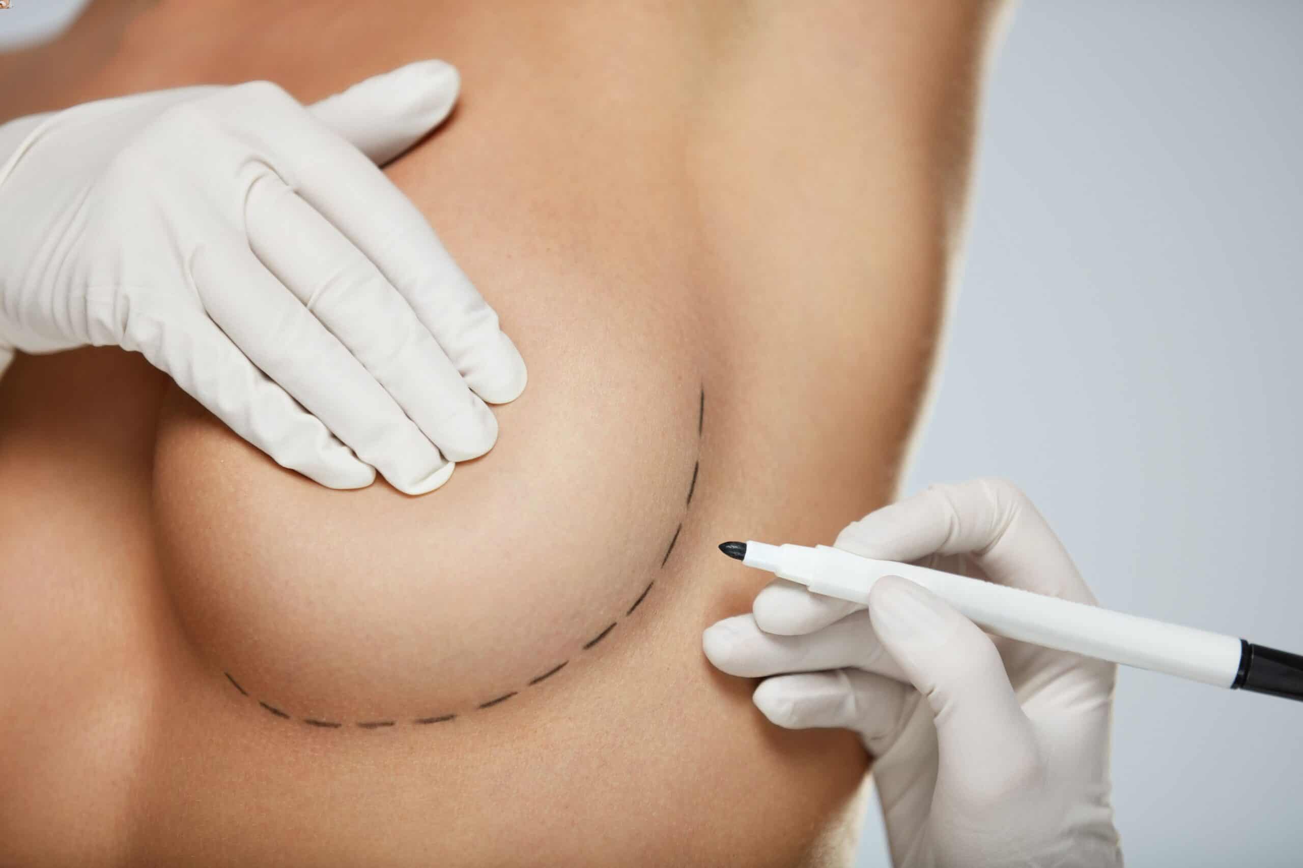 Breast Reconstruction