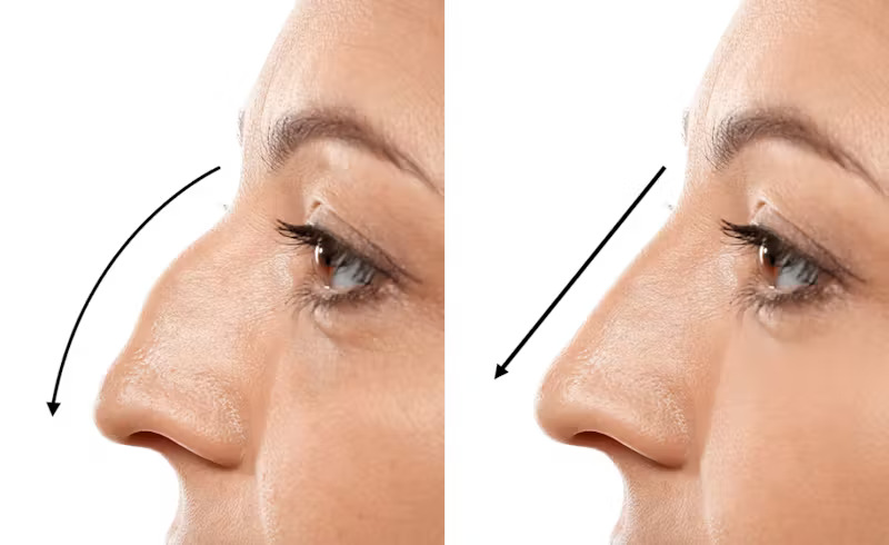Understanding Secondary Rhinoplasty in Mumbai