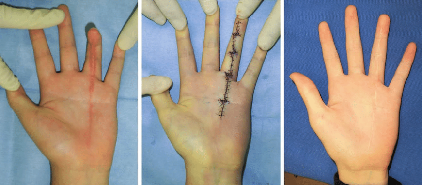 Understanding Hand Surgery