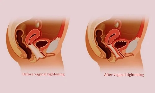 Understanding Vaginal Tightening in Mumbai By Dr. Vinay Jacob