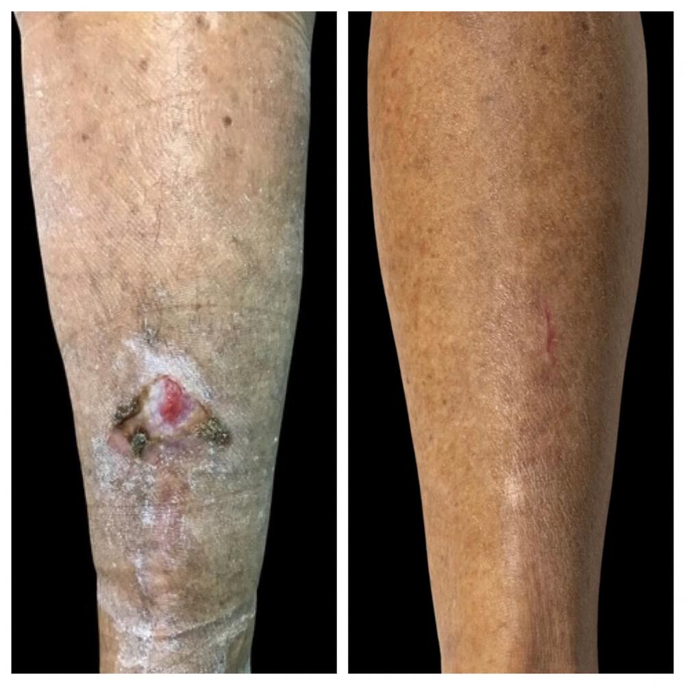 Understanding Chronic Wounds in Mumbai with Dr. Vinay jacob