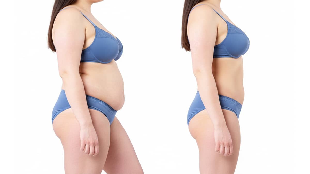 What Exactly Is a Mommy Makeover?