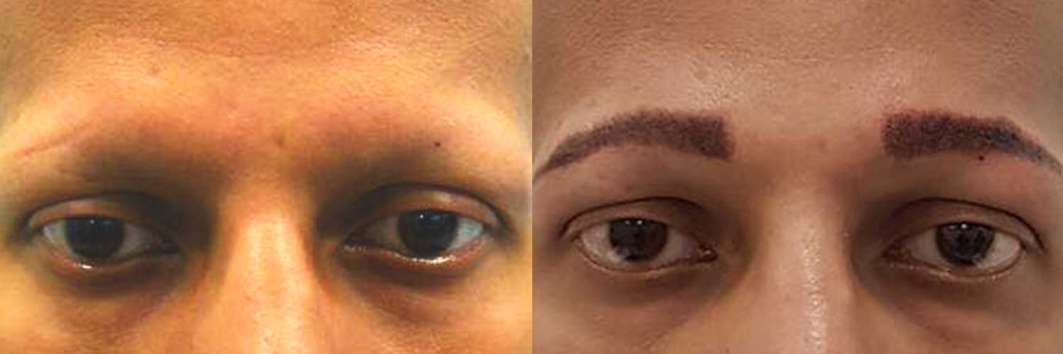 Eyebrow Hair Transplant in Mumbai by Dr. Vinay Jacob