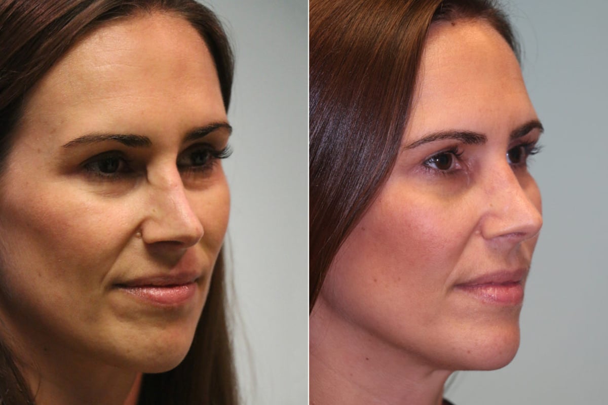 What Is Secondary Rhinoplasty