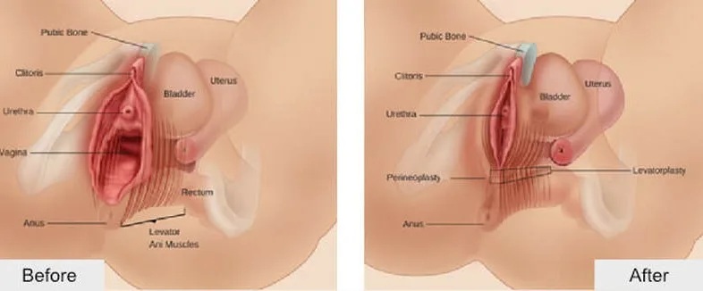 Understanding Vaginal Tightening in Mumbai By Dr. Vinay Jacob