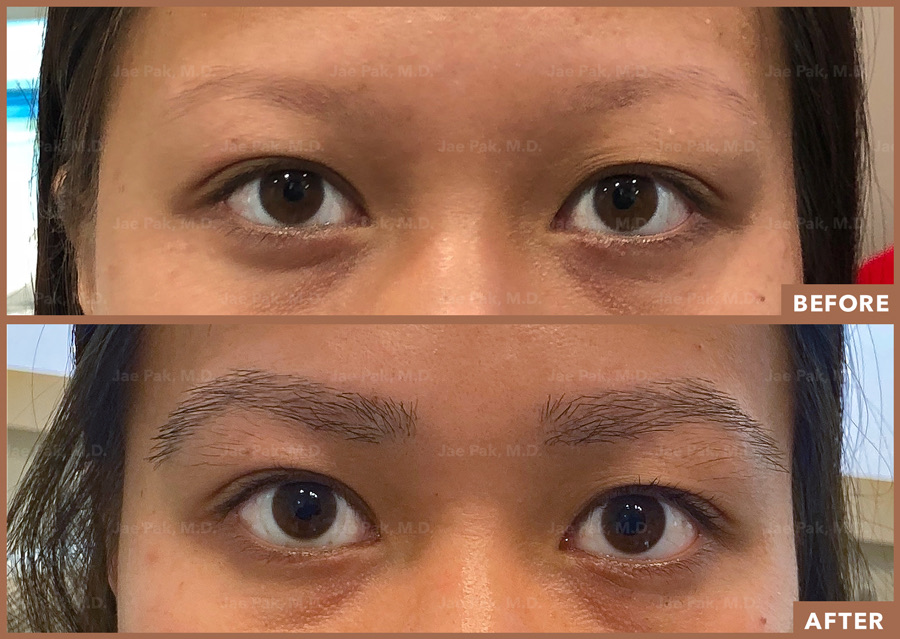 Why Choose Eyebrow Hair Transplant In Mumbai