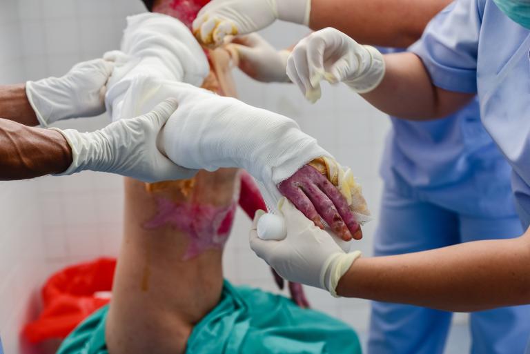 Surgical Reconstruction for Improved Healing After Burns
