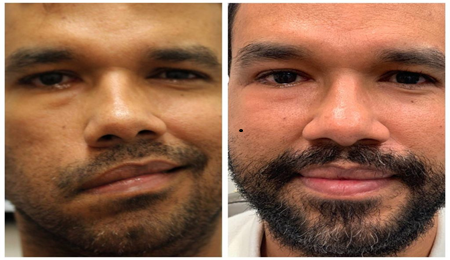 facial nerve reconstructions
