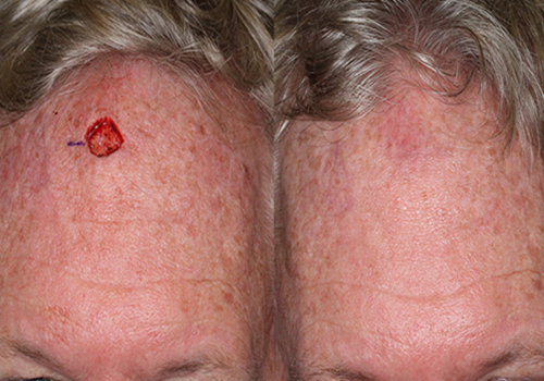 Corrective Jaw Surgery