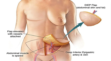 flap reconstruction