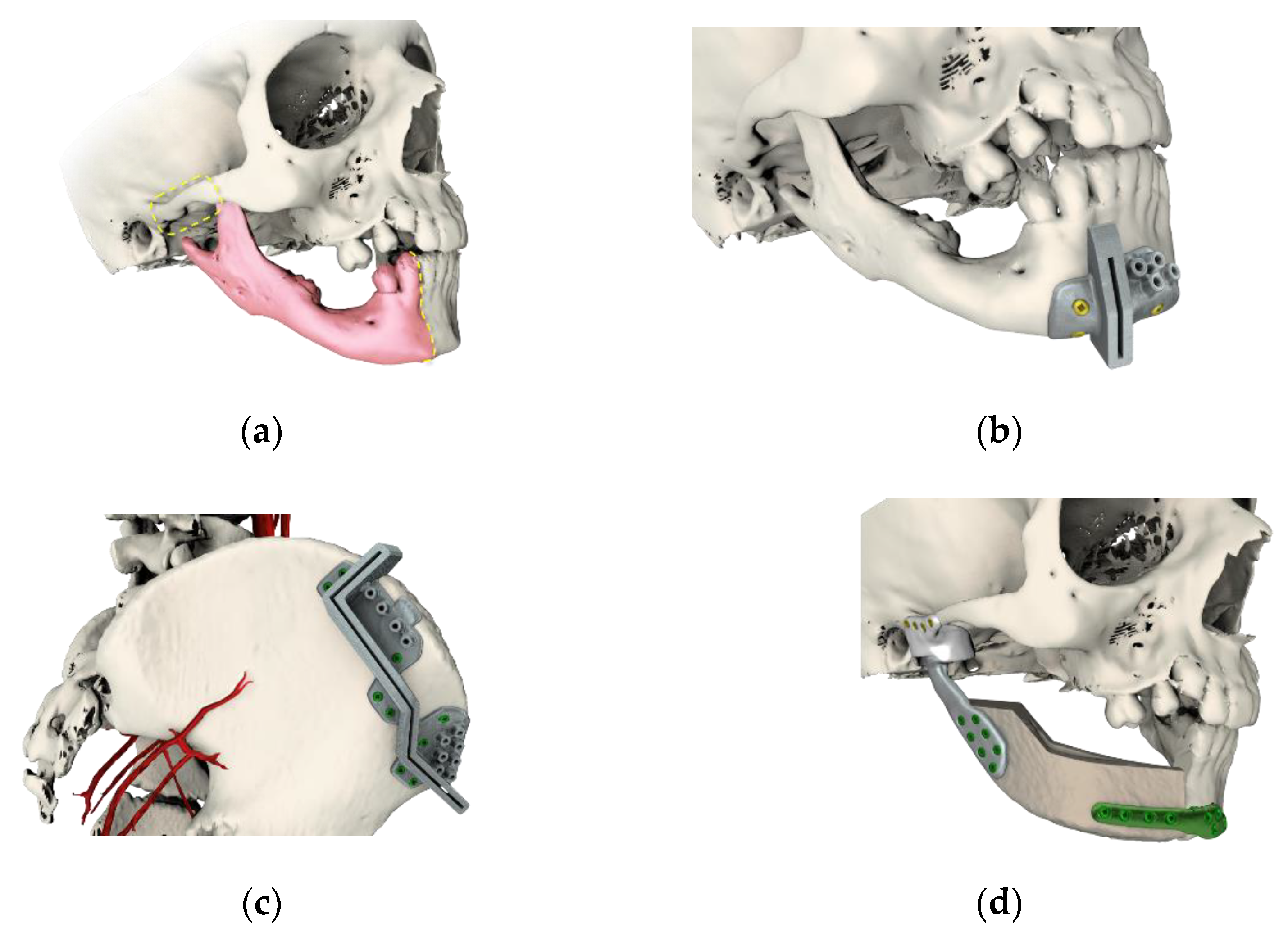 How 3D Printing Improves Surgical Planning