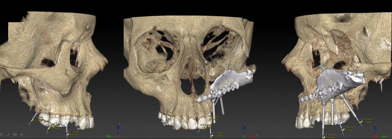 Combining AI and 3D Printing for Personalized Surgery