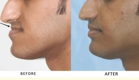 Jaw Reconstruction